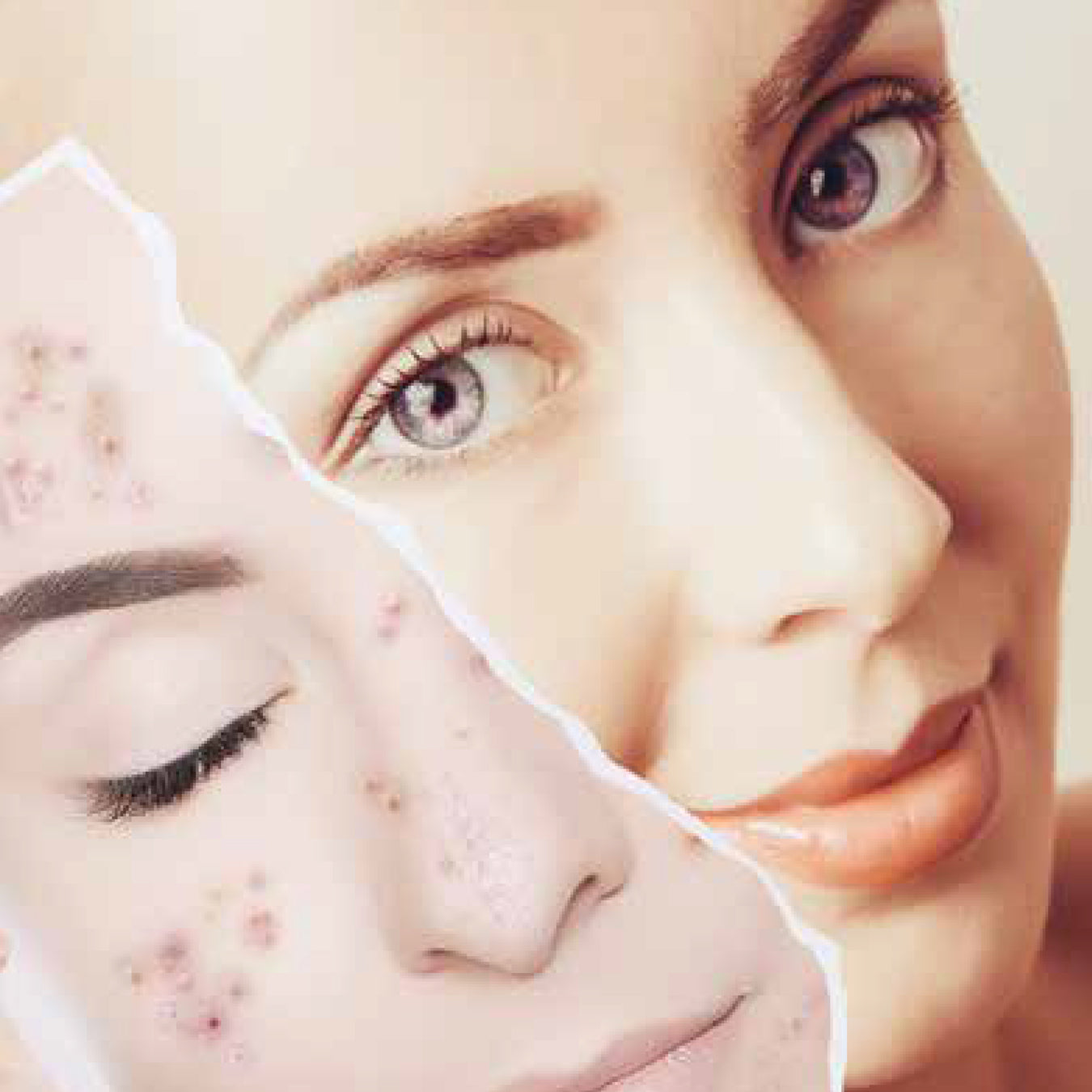 IPL Skin Treatment